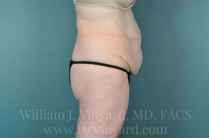 Tummy Tuck Before & After Gallery - Patient 171444238 - Image 5