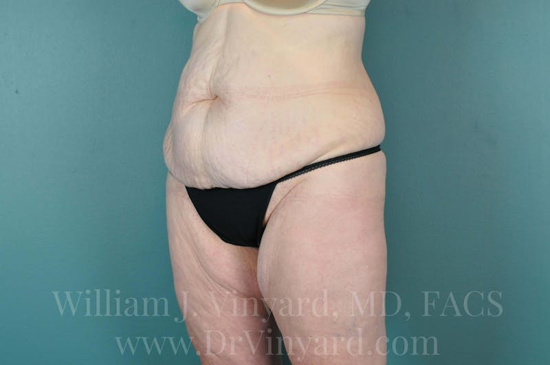 Tummy Tuck Before & After Gallery - Patient 171444238 - Image 7