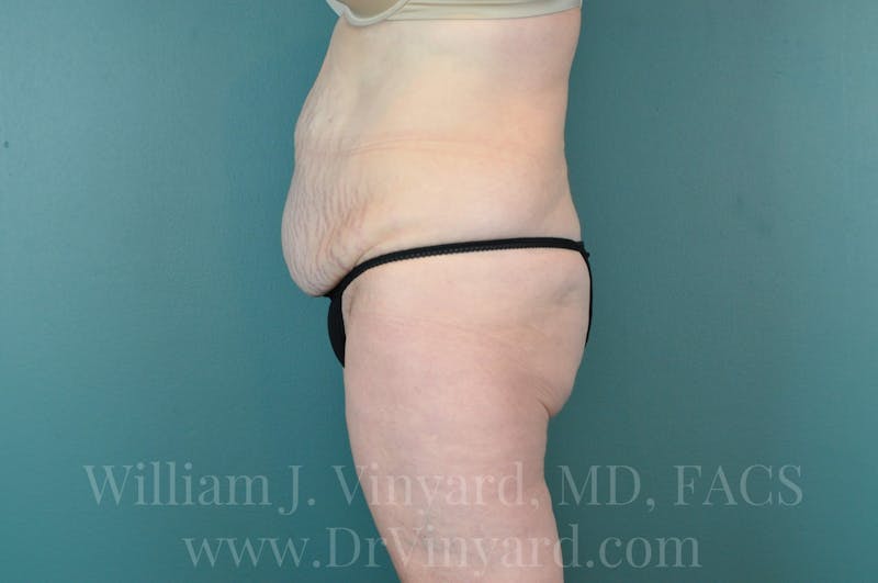 Tummy Tuck Before & After Gallery - Patient 171444238 - Image 9