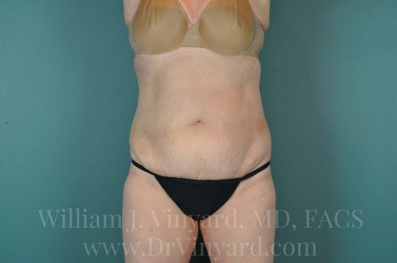 Tummy Tuck Before & After Gallery - Patient 171444272 - Image 1