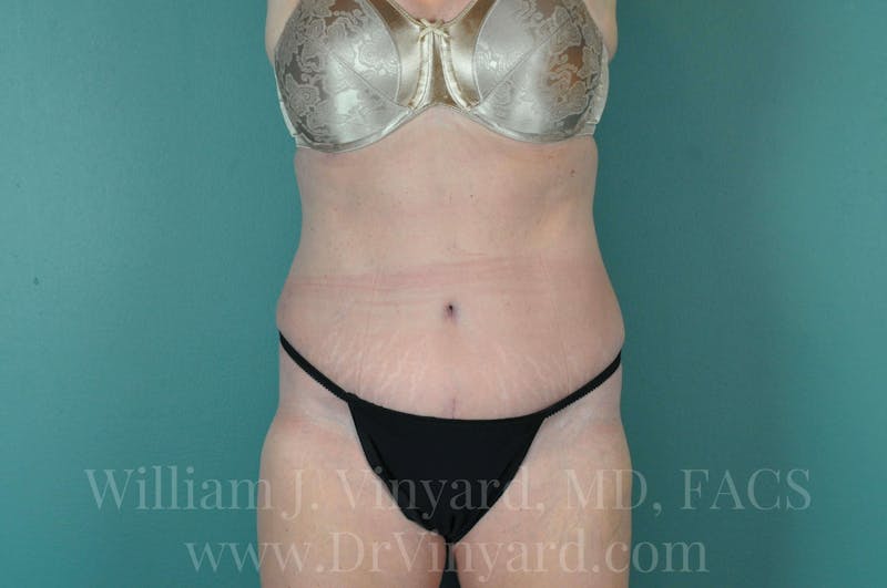 Tummy Tuck Before & After Gallery - Patient 171444272 - Image 2