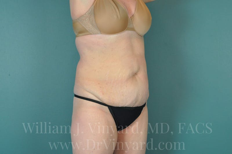 Tummy Tuck Before & After Gallery - Patient 171444272 - Image 3
