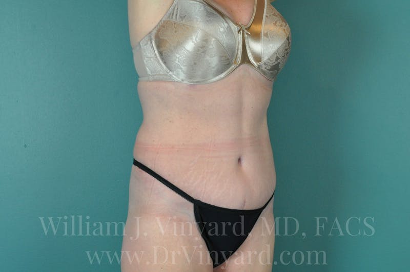 Tummy Tuck Before & After Gallery - Patient 171444272 - Image 4