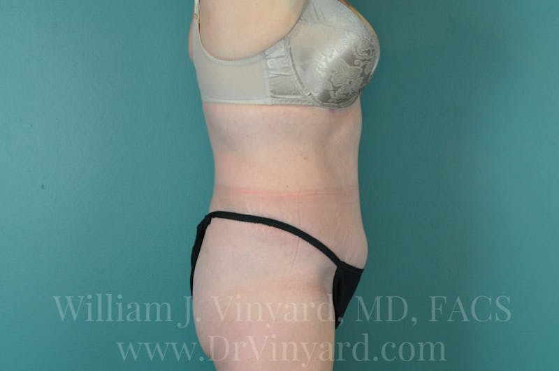 Tummy Tuck Before & After Gallery - Patient 171444272 - Image 6
