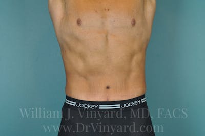 Tummy Tuck Before & After Gallery - Patient 171444299 - Image 2