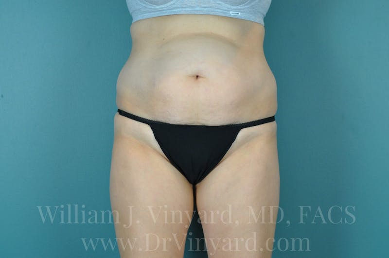 Tummy Tuck Before & After Gallery - Patient 171444300 - Image 1