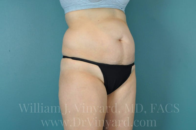Tummy Tuck Before & After Gallery - Patient 171444300 - Image 3