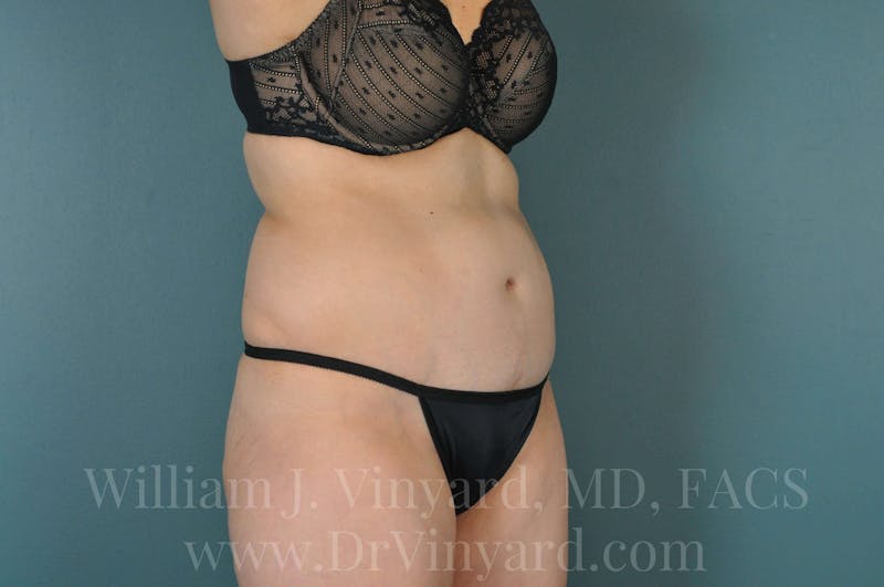 Tummy Tuck Before & After Gallery - Patient 171444300 - Image 4
