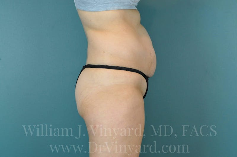 Tummy Tuck Before & After Gallery - Patient 171444300 - Image 5