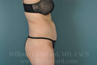 Tummy Tuck Before & After Gallery - Patient 171444300 - Image 6