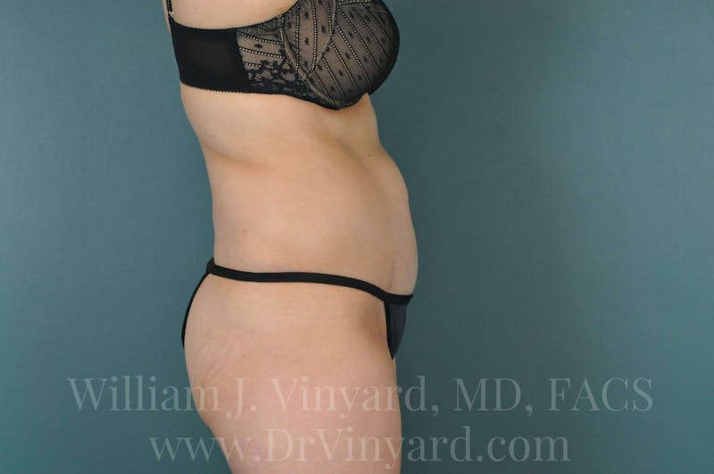 Tummy Tuck Before & After Gallery - Patient 171444300 - Image 6