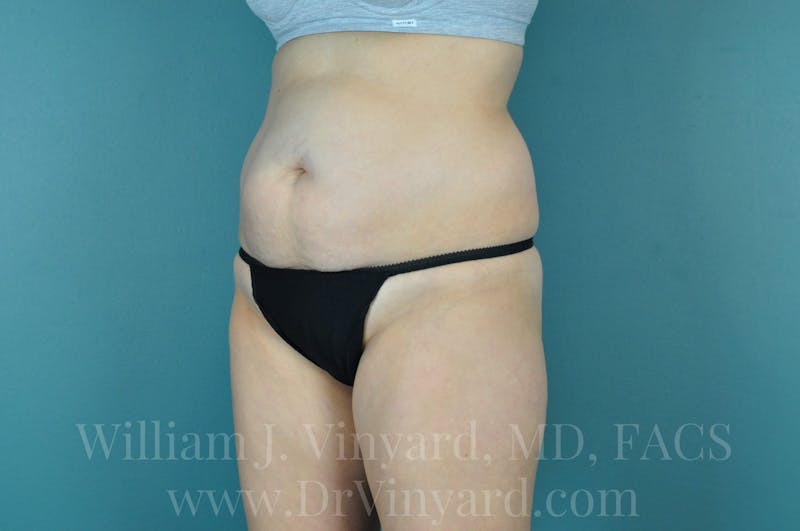 Tummy Tuck Before & After Gallery - Patient 171444300 - Image 7
