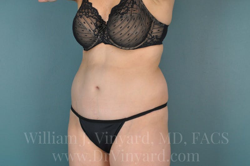 Tummy Tuck Before & After Gallery - Patient 171444300 - Image 8