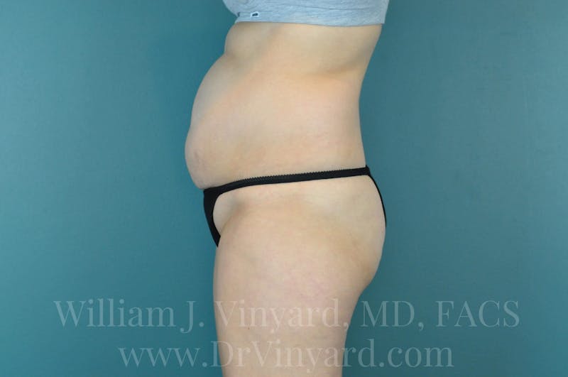 Tummy Tuck Before & After Gallery - Patient 171444300 - Image 9