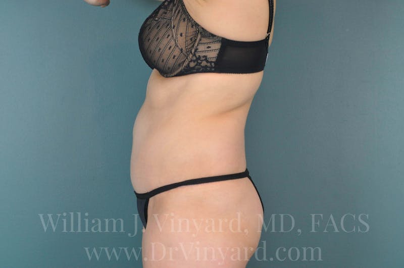 Tummy Tuck Before & After Gallery - Patient 171444300 - Image 10