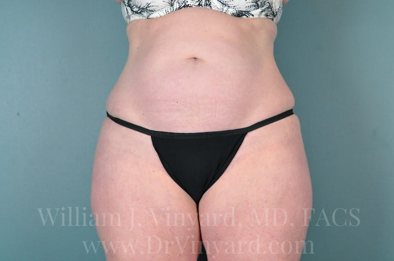 Tummy Tuck Before & After Gallery - Patient 171444749 - Image 1