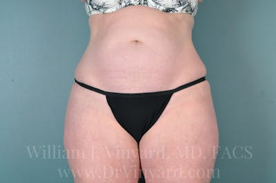 Tummy Tuck Before & After Gallery - Patient 171444749 - Image 1