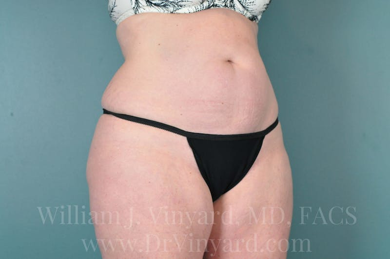 Tummy Tuck Before & After Gallery - Patient 171444749 - Image 3