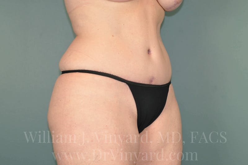 Tummy Tuck Before & After Gallery - Patient 171444749 - Image 4