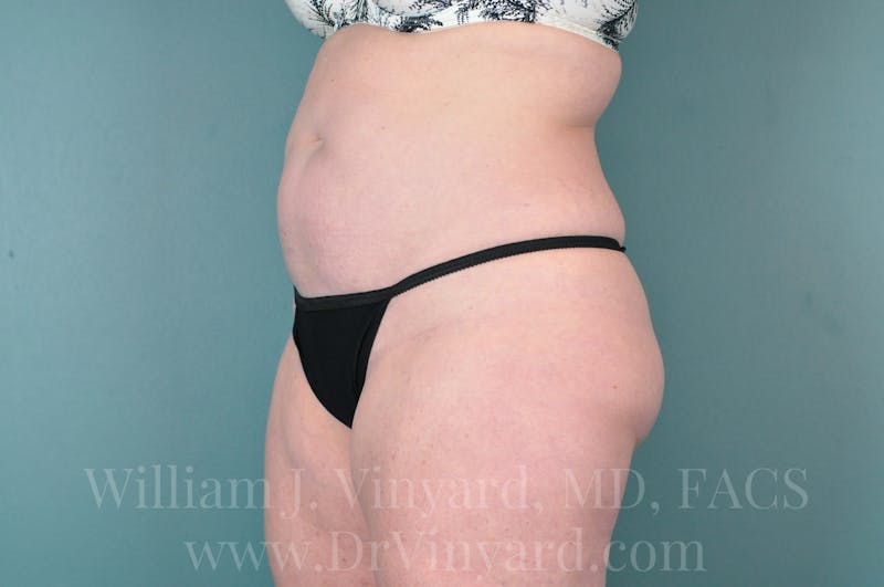 Tummy Tuck Before & After Gallery - Patient 171444749 - Image 7