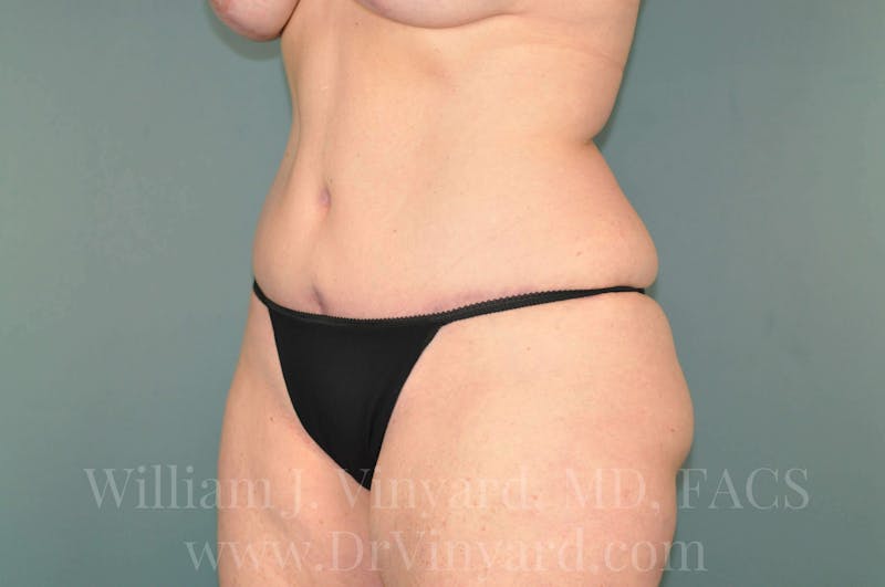 Tummy Tuck Before & After Gallery - Patient 171444749 - Image 8
