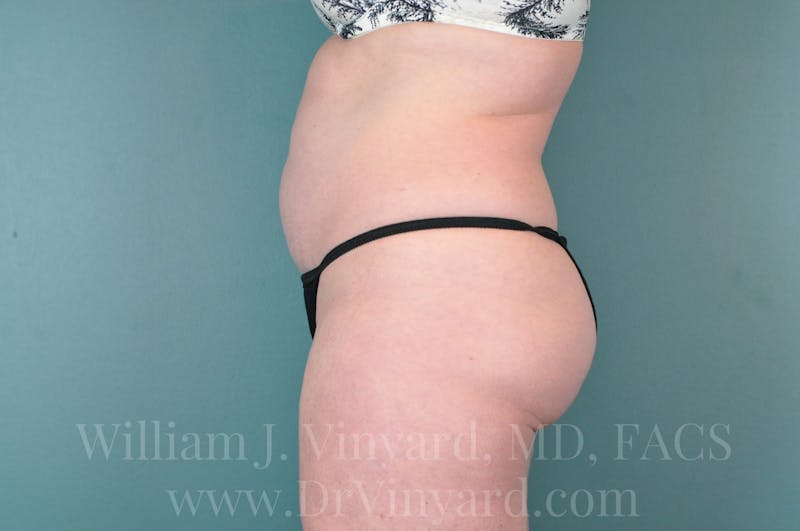 Tummy Tuck Before & After Gallery - Patient 171444749 - Image 9