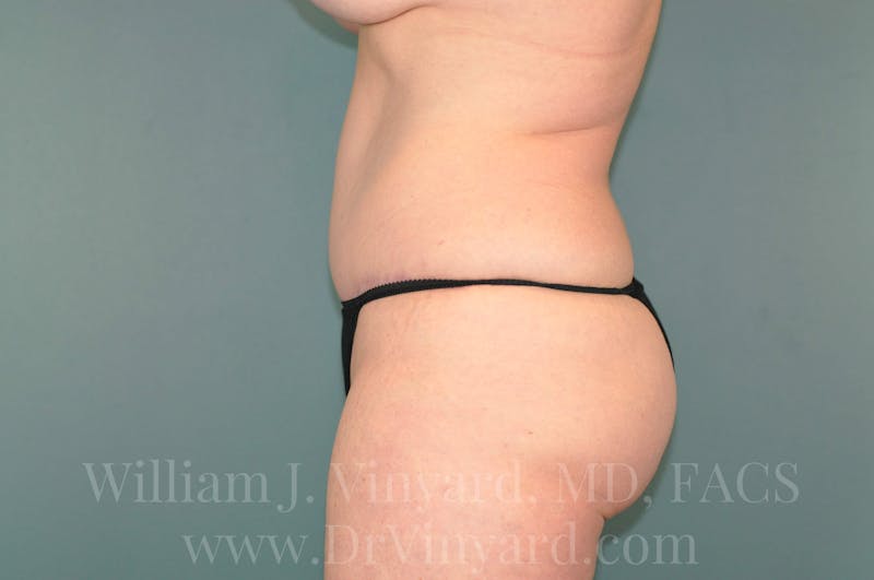 Tummy Tuck Before & After Gallery - Patient 171444749 - Image 10