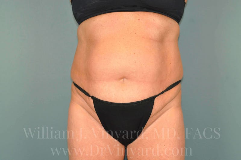 Tummy Tuck Before & After Gallery - Patient 171444813 - Image 1