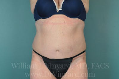 Tummy Tuck Before & After Gallery - Patient 171444813 - Image 2