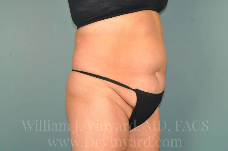 Tummy Tuck Before & After Gallery - Patient 171444813 - Image 3