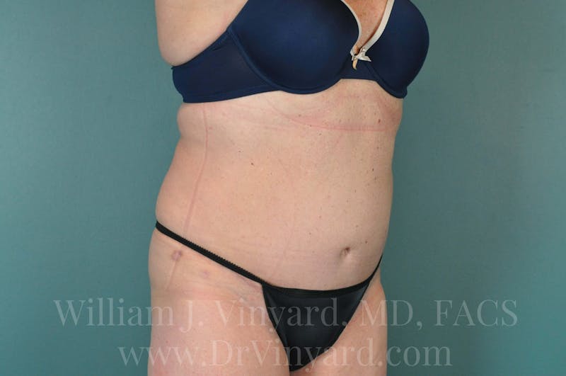 Tummy Tuck Before & After Gallery - Patient 171444813 - Image 4