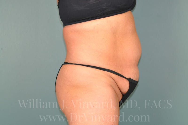 Tummy Tuck Before & After Gallery - Patient 171444813 - Image 5