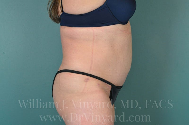 Tummy Tuck Before & After Gallery - Patient 171444813 - Image 6