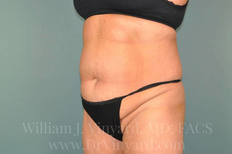 Tummy Tuck Before & After Gallery - Patient 171444813 - Image 7