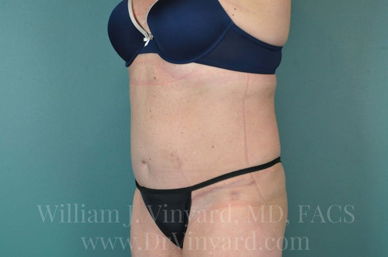 Tummy Tuck Before & After Gallery - Patient 171444813 - Image 8