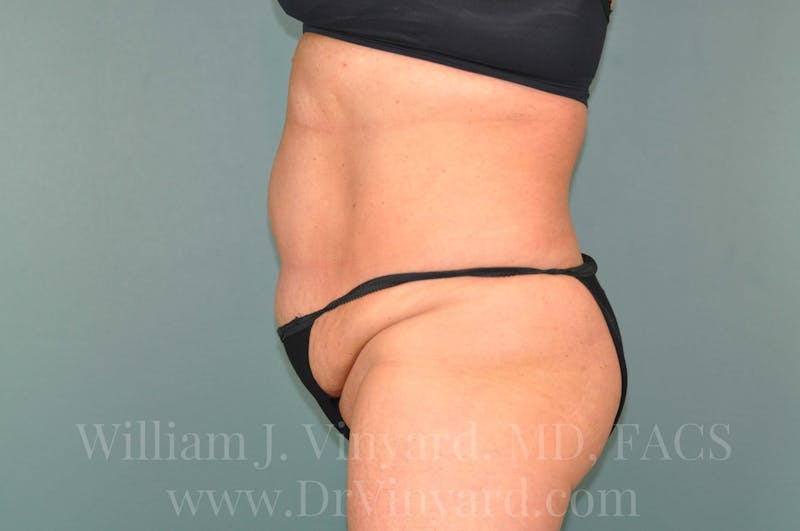 Tummy Tuck Before & After Gallery - Patient 171444813 - Image 9