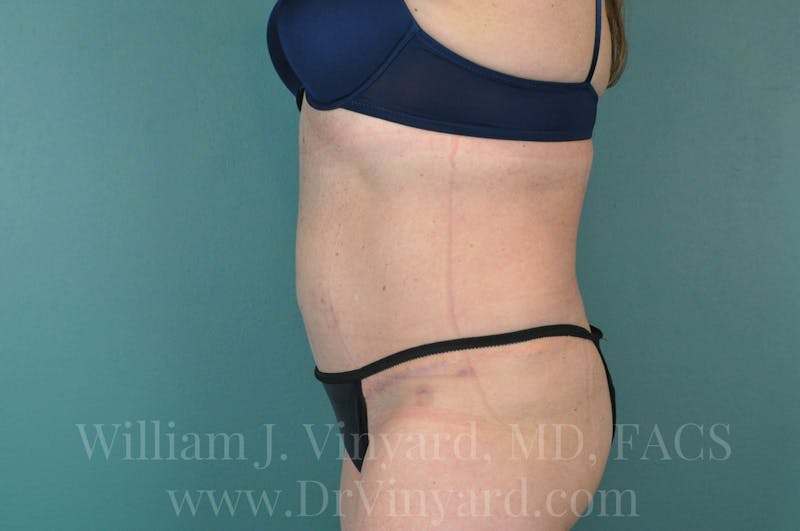 Tummy Tuck Before & After Gallery - Patient 171444813 - Image 10