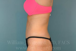 Mommy Makeover Before & After Gallery - Patient 171445595 - Image 10