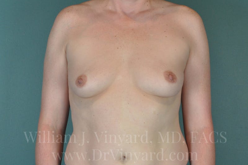 Breast Augmentation Before & After Gallery - Patient 171446670 - Image 3