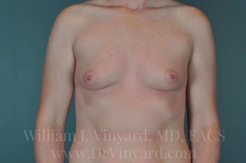 Breast Augmentation Before & After Gallery - Patient 171446710 - Image 3