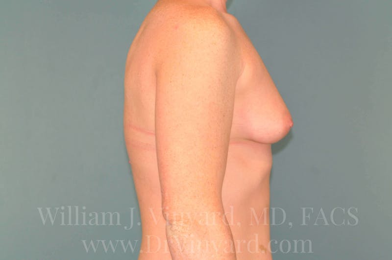 Breast Augmentation Before & After Gallery - Patient 171446710 - Image 5