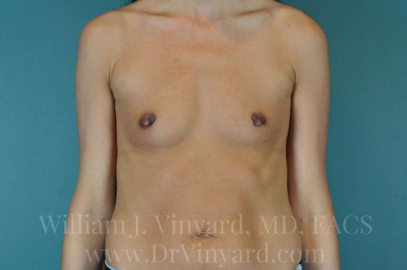 Breast Augmentation Before & After Gallery - Patient 171446733 - Image 3