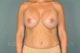 Breast Augmentation Before & After Gallery - Patient 171447278 - Image 4