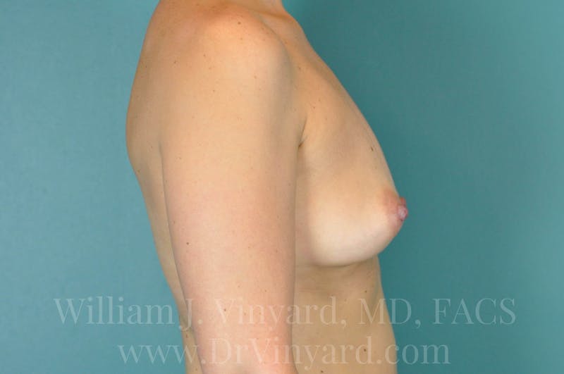 Breast Augmentation Before & After Gallery - Patient 171447278 - Image 5