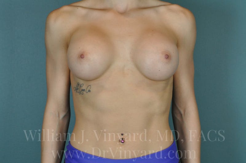 Breast Augmentation Before & After Gallery - Patient 171447304 - Image 4