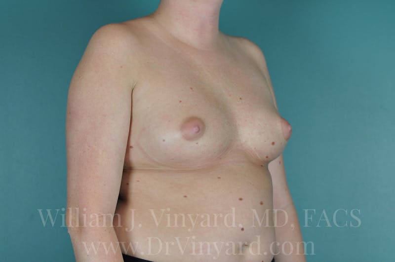 Breast Augmentation Before & After Gallery - Patient 171447711 - Image 1
