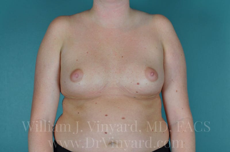 Breast Augmentation Before & After Gallery - Patient 171447711 - Image 3