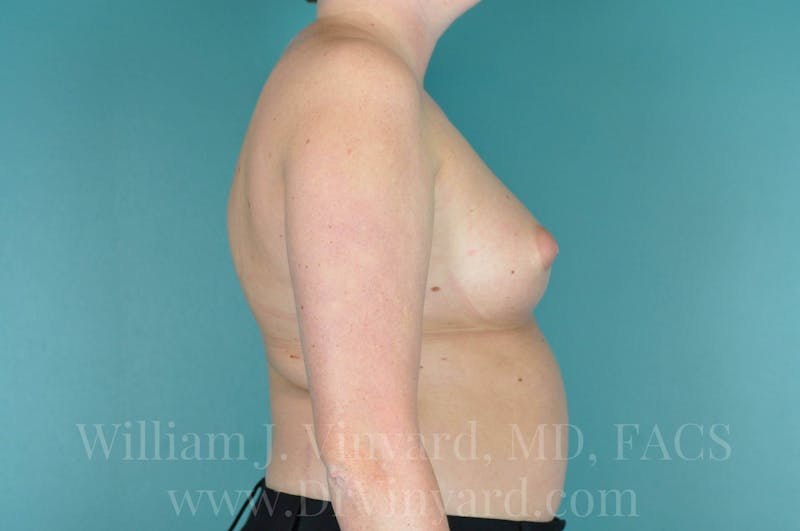 Breast Augmentation Before & After Gallery - Patient 171447711 - Image 5