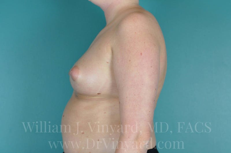 Breast Augmentation Before & After Gallery - Patient 171447711 - Image 9