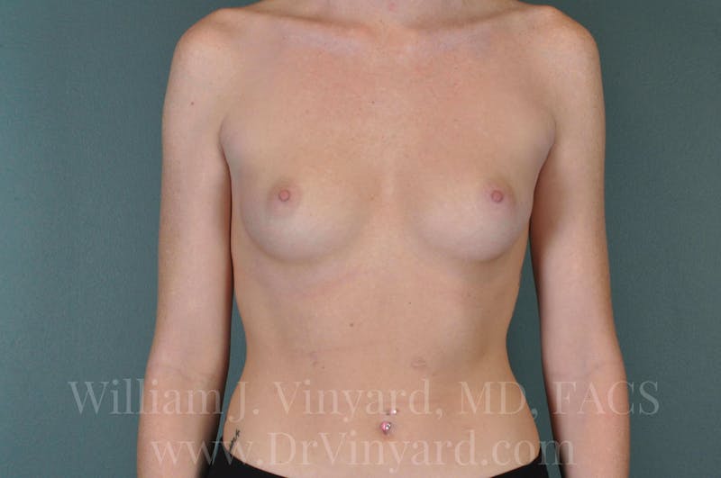 Breast Augmentation Before & After Gallery - Patient 171447863 - Image 3
